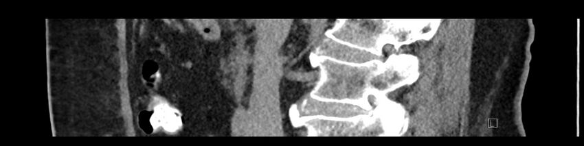 Buried bumper syndrome - gastrostomy tube (Radiopaedia 63843-72575 Sagittal Inject 70).jpg