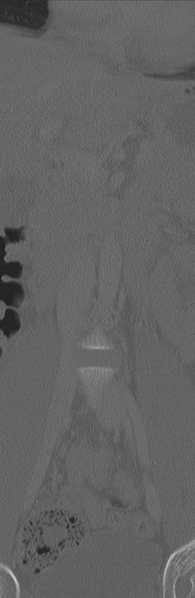 File:Burst fracture - T12 with conus compression (Radiopaedia 56825-63647 Coronal bone window 5).png