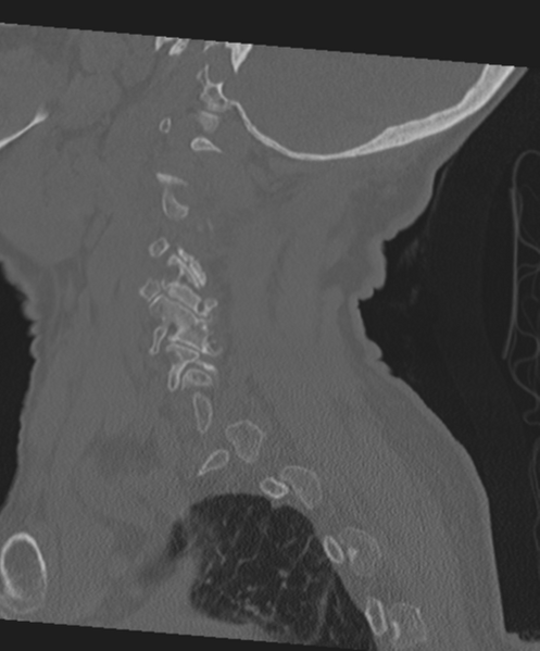 File:C2 fracture with vertebral artery dissection (Radiopaedia 37378-39199 Sagittal bone window 22).png