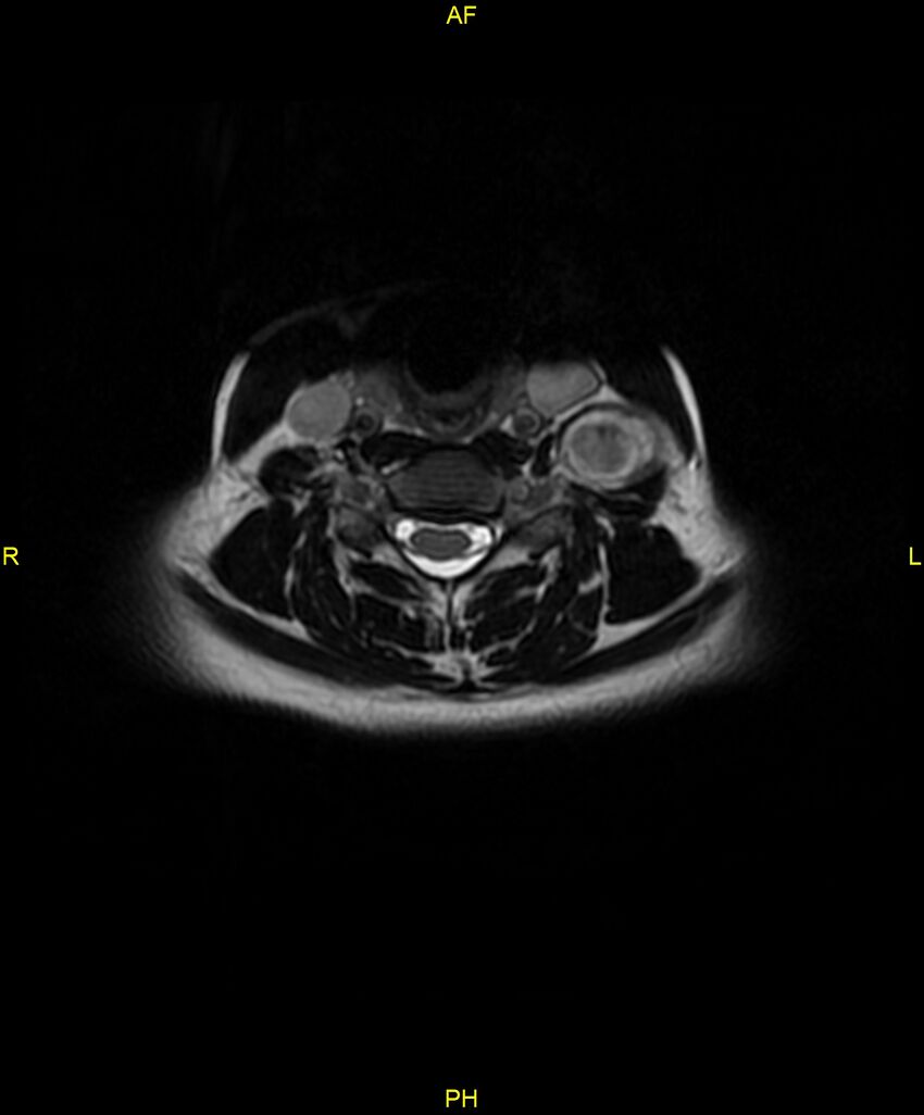 C5 nerve sheath tumor (Radiopaedia 85777-101596 Axial T2 41).jpg