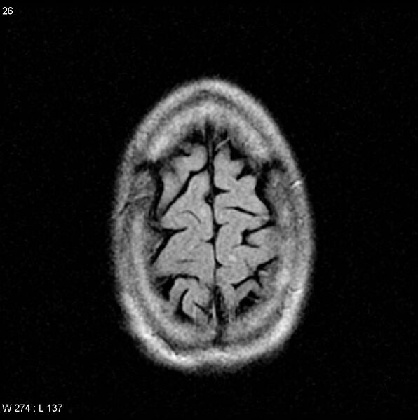 File:CMV ventriculitis and encephalitis (Radiopaedia 5416-7166 Axial FLAIR 10).jpg