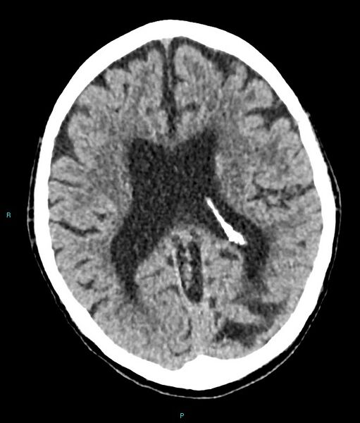 File:Calcified cerebral emboli from left ventricular thrombus (Radiopaedia 84420-99758 Axial non-contrast 43).jpg