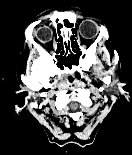 File:Calcified cerebral emboli from left ventricular thrombus (Radiopaedia 84420-99758 Axial non-contrast 84).jpg