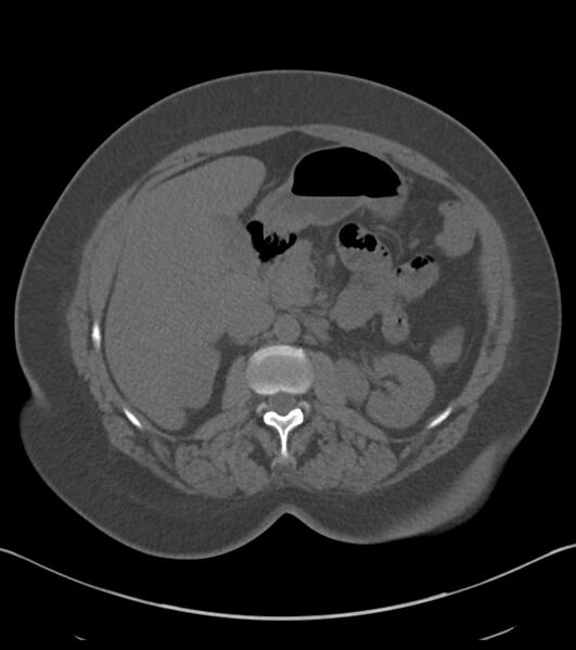 File:Calcified hepatic hydatid cyst (Radiopaedia 81127-94738 Axial non-contrast 37).jpg