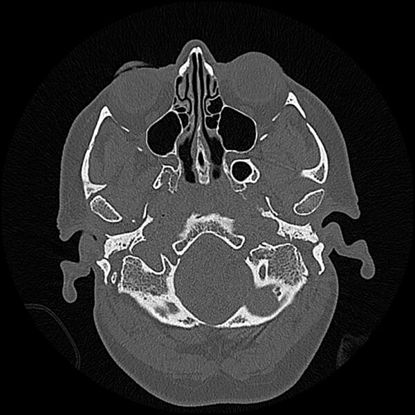 File:Canal up mastoidectomy (Radiopaedia 78108-90638 Axial bone window 27).jpg