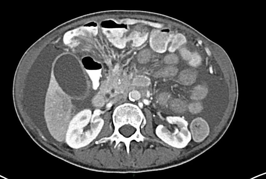 Carcinoid mesenteric tumor complicated by chylous ascites (Radiopaedia 76312-87953 A 30).jpg