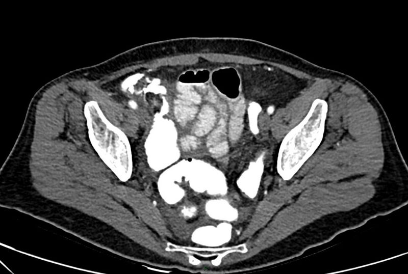 File:Carcinoid mesenteric tumor complicated by chylous ascites (Radiopaedia 76312-88926 A 64).jpg