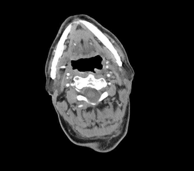 File:Carotid artery pseudoaneurysm (Radiopaedia 84030-99259 C 28).jpg