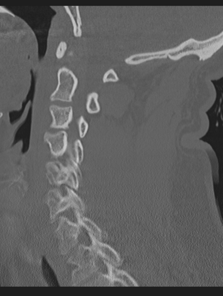 File:Cavernoma of cervical cord (Radiopaedia 50838-56346 Sagittal bone window 35).png