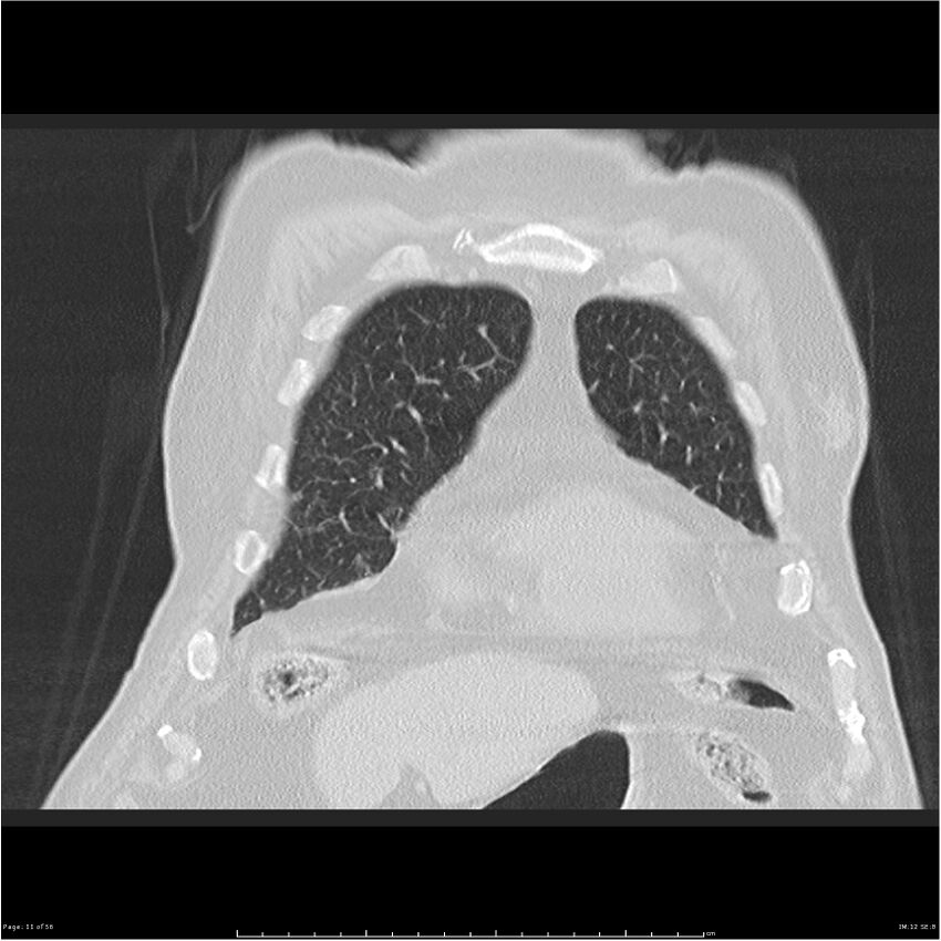 Cavitating left lower lobe lesion - squamous cell lung cancer (Radiopaedia 27749-28176 Coronal lung window 11).jpg