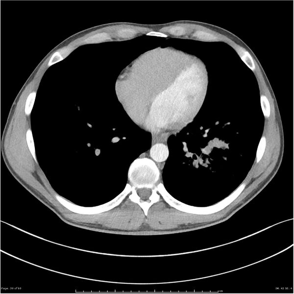 File:Cavitating lung cancer (Radiopaedia 25796-25945 C+ arterial phase 39).jpg
