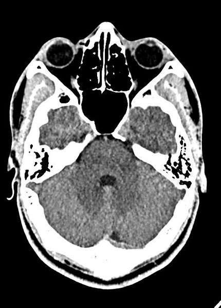 File:Cavum septum pellucidum and cavum vergae (Radiopaedia 77797-90060 Axial Brain Window 30).jpg