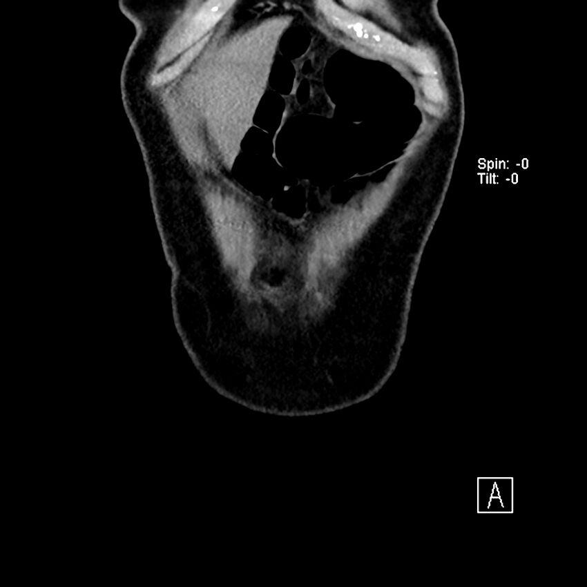 Cecal volvulus (Radiopaedia 90897-108397 Coronal non-contrast 55).jpg