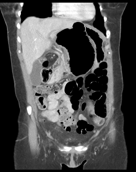 File:Cecum hernia through the foramen of Winslow (Radiopaedia 46634-51112 B 15).png