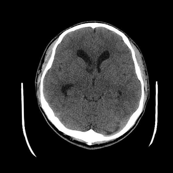 File:Central neurocytoma (Radiopaedia 79320-92379 Axial non-contrast 22).jpg