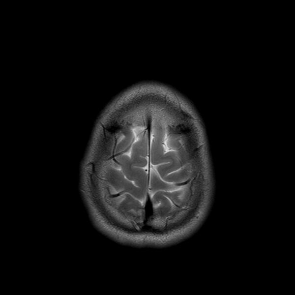File:Central neurocytoma (Radiopaedia 79320-92380 Axial T2 25).jpg