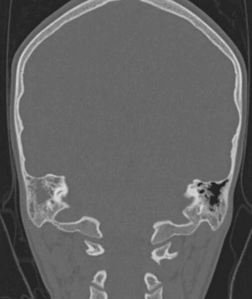 File:Cerebellar abscess (Radiopaedia 73727-84527 Coronal bone window 38).jpg