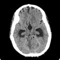Cerebellar abscess secondary to mastoiditis (Radiopaedia 26284-26412 Axial non-contrast 60).jpg