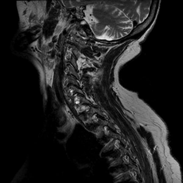 File:Cerebellar ataxia with neuropathy and vestibular areflexia syndrome (CANVAS) (Radiopaedia 74283-85159 Sagittal T2 1).jpg