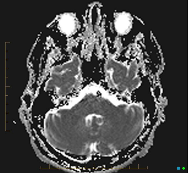 File:Cerebellar gangliocytoma (Radiopaedia 65377-74422 Axial ADC 9).jpg
