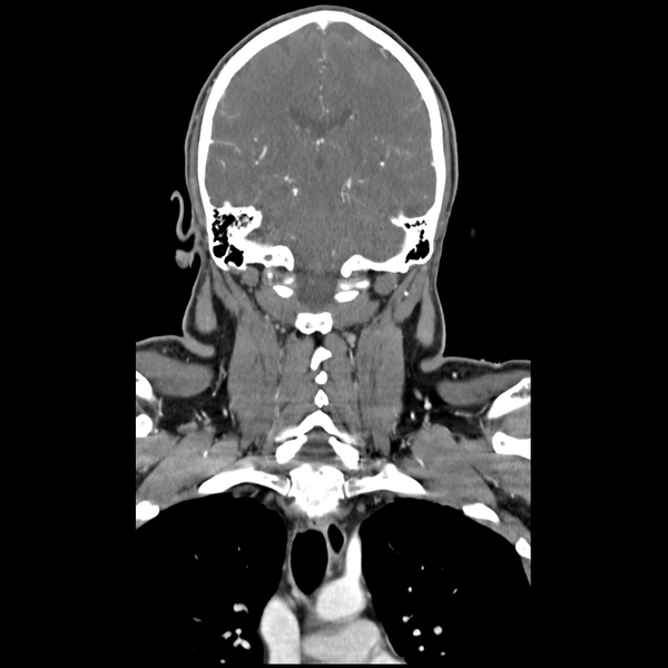 File:Cerebellar infarct due to vertebral artery dissection with posterior fossa decompression (Radiopaedia 82779-97029 D 38).png