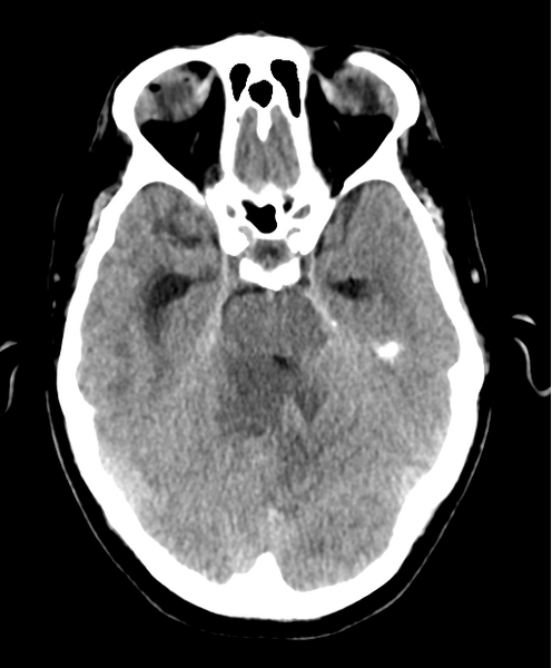File:Cerebellar metastasis from lung adenocarcinoma (Radiopaedia 86690-102828 Axial non-contrast 10).png