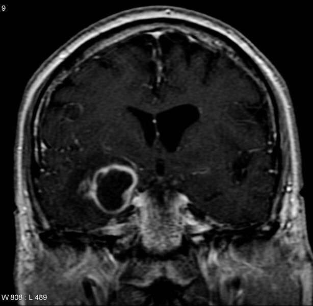 File:Cerebral abscess and ventriculitis (Radiopaedia 5024-6885 Coronal T1 C+ 1).jpg
