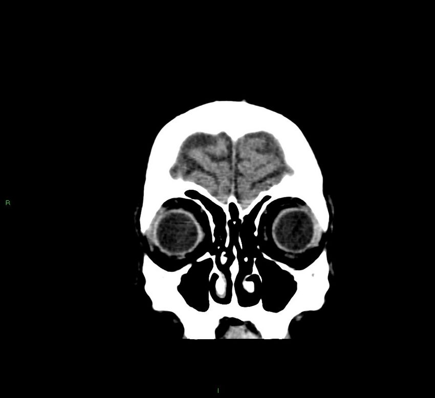 Cerebral amyloid angiopathy-associated lobar intracerebral hemorrhage (Radiopaedia 58376-65511 Coronal non-contrast 57).jpg