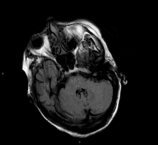 File:Cerebral amyloid angiopathy-associated lobar intracerebral hemorrhage (Radiopaedia 58377-65515 Axial FLAIR 20).jpg