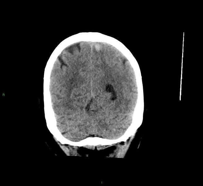 File:Cerebral amyloid angiopathy-associated lobar intracerebral hemorrhage (Radiopaedia 58529-65681 Coronal non-contrast 18).jpg