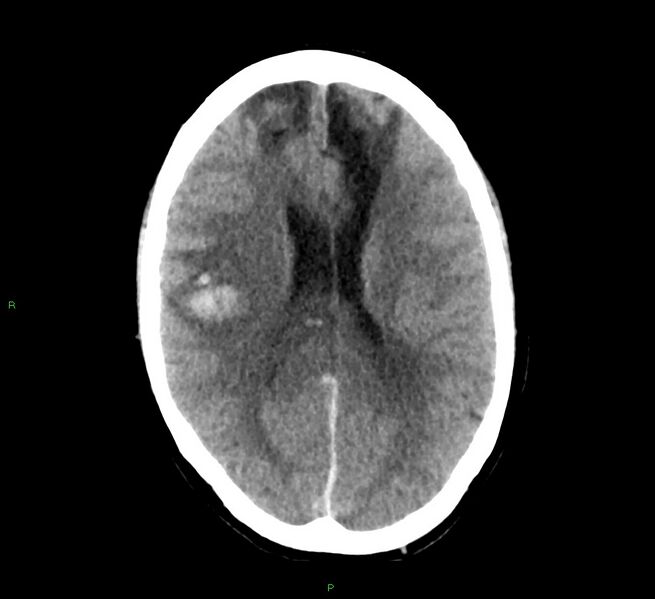 File:Cerebral amyloid angiopathy-associated lobar intracerebral hemorrhage (Radiopaedia 58529-65687 Axial non-contrast 23).jpg