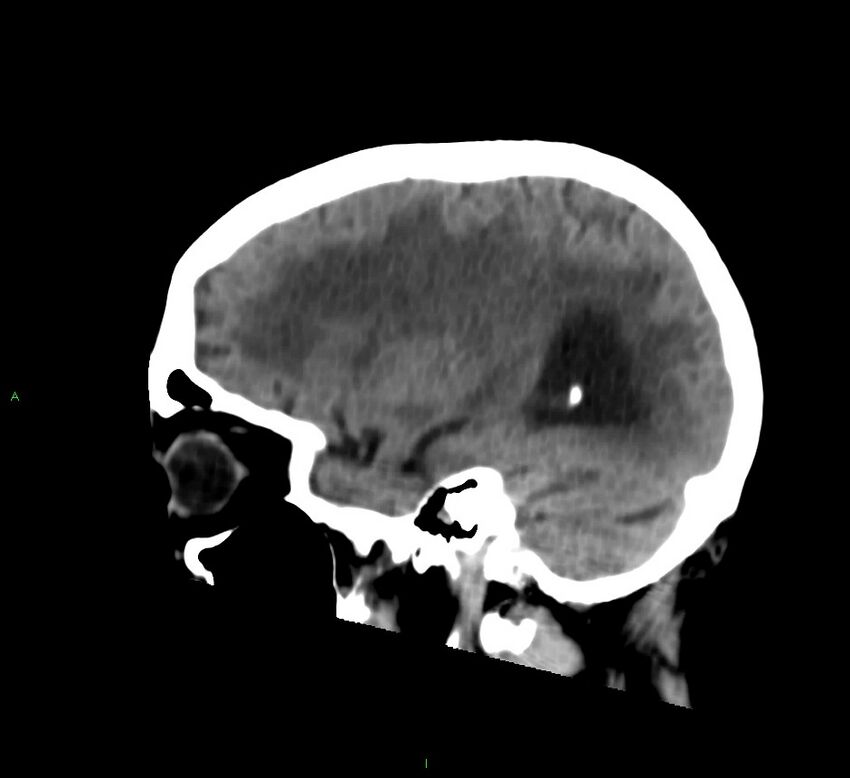 Cerebral amyloid angiopathy-associated lobar intracerebral hemorrhage (Radiopaedia 58530-65688 C 17).jpg