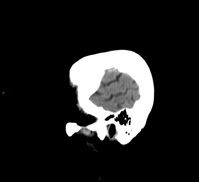 File:Cerebral amyloid angiopathy-associated lobar intracerebral hemorrhage (Radiopaedia 58530-65688 C 7).jpg