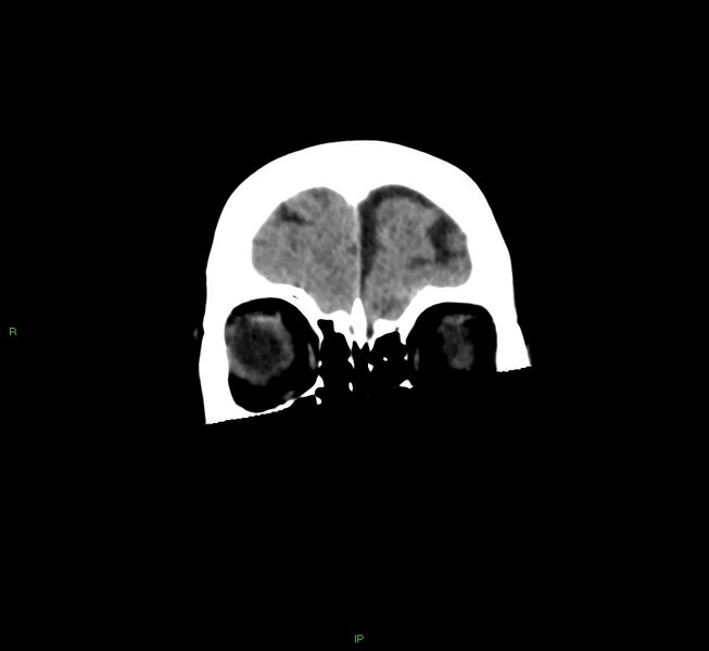 File:Cerebral amyloid angiopathy-associated lobar intracerebral hemorrhage (Radiopaedia 58563-65727 Coronal non-contrast 55).jpg