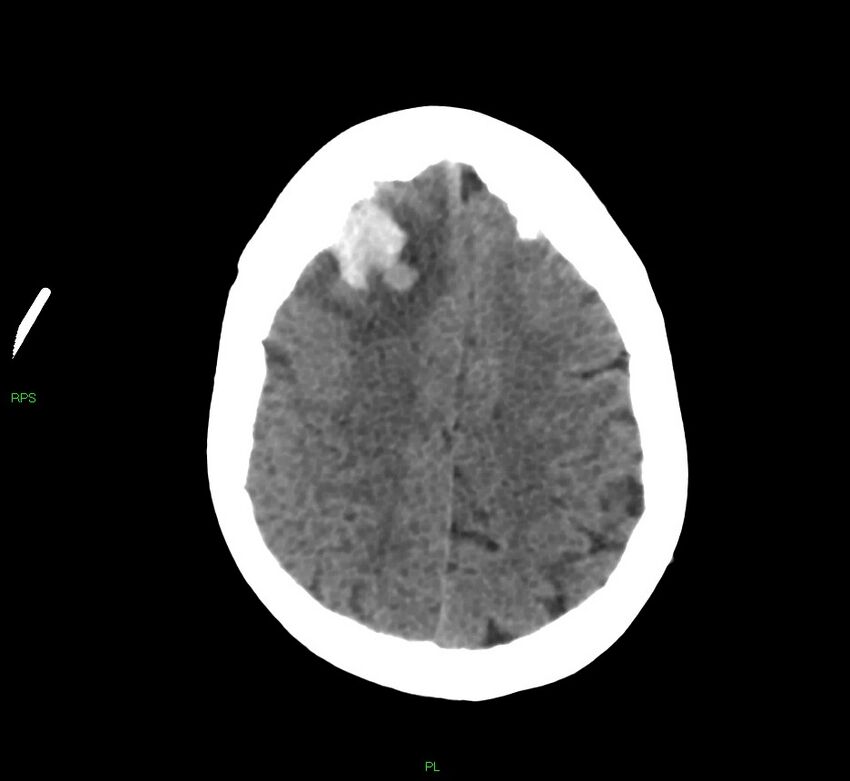 Cerebral amyloid angiopathy-associated lobar intracerebral hemorrhage (Radiopaedia 58569-65734 Axial non-contrast 21).jpg