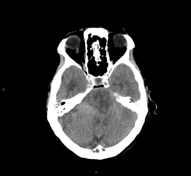 File:Cerebral amyloid angiopathy-associated lobar intracerebral hemorrhage (Radiopaedia 58751-65972 Axial non-contrast 35).jpg