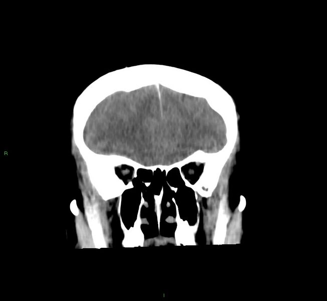 File:Cerebral amyloid angiopathy-associated lobar intracerebral hemorrhage (Radiopaedia 58756-65977 Coronal non-contrast 49).jpg