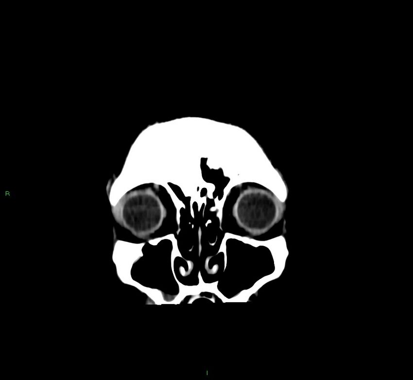Cerebral amyloid angiopathy-associated lobar intracerebral hemorrhage (Radiopaedia 58756-65977 Coronal non-contrast 58).jpg