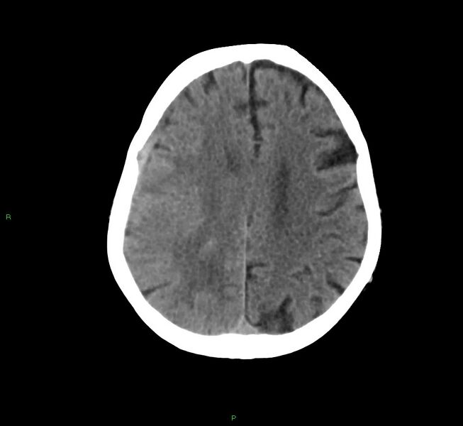 File:Cerebral amyloid angiopathy-associated lobar intracerebral hemorrhage (Radiopaedia 58758-65980 Axial non-contrast 17).jpg
