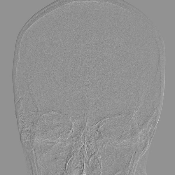 File:Cerebral aneurysm with rupture (Radiopaedia 29933-30458 LT CCA IC 8).jpg