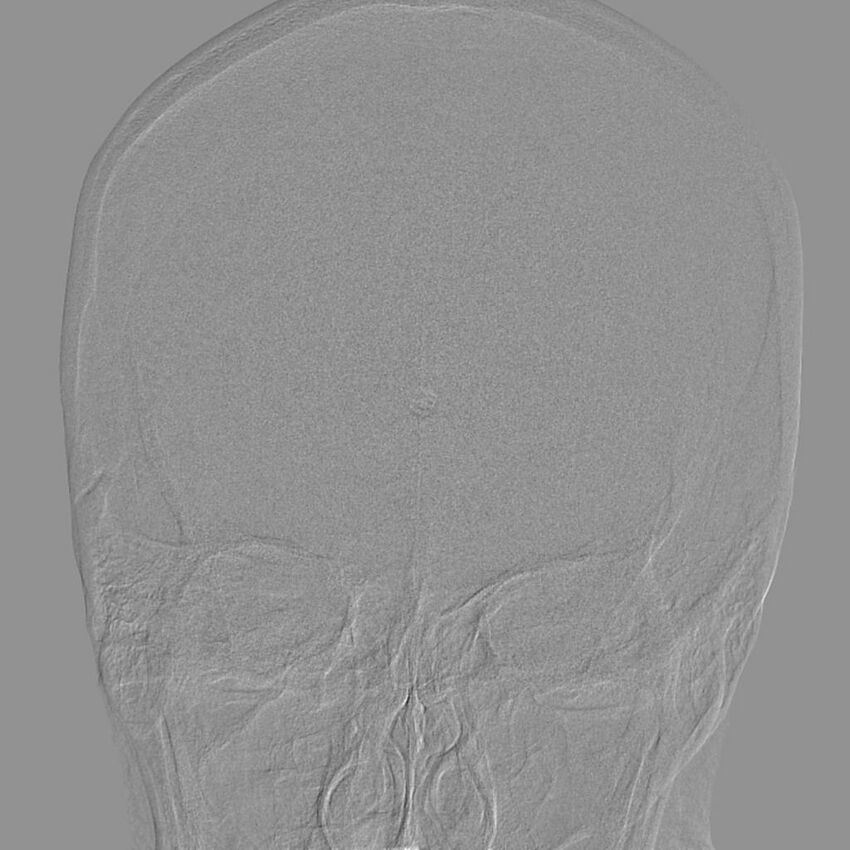Cerebral aneurysm with rupture (Radiopaedia 29933-30458 LT CCA IC 8).jpg