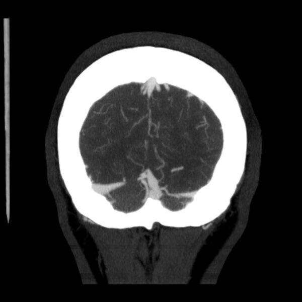 File:Cerebral arteriovenous malformation (Radiopaedia 43729-47189 C 43).jpg