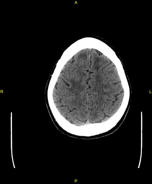 File:Cerebral autosomal dominant arteriopathy with subcortical infarcts and leukoencephalopathy (CADASIL) (Radiopaedia 86108-102051 Axial non-contrast 90).jpg