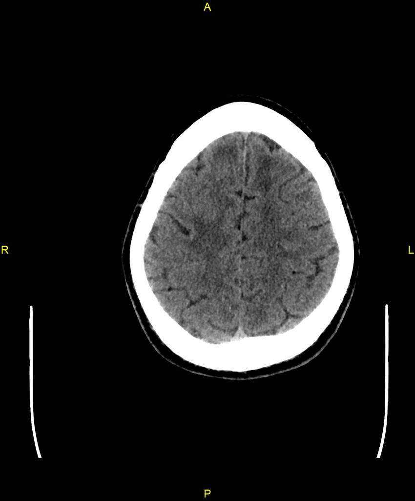 Cerebral autosomal dominant arteriopathy with subcortical infarcts and leukoencephalopathy (CADASIL) (Radiopaedia 86108-102051 Axial non-contrast 90).jpg