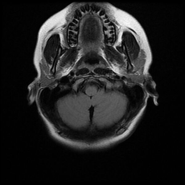 File:Cerebral cavernous malformation (Radiopaedia 44301-47942 Axial FLAIR 3).jpg