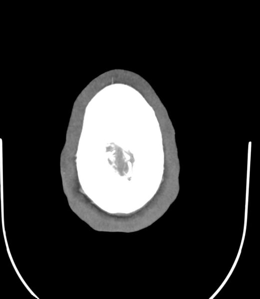 File:Cerebral dural venous sinus thrombosis (Radiopaedia 86514-102576 A 90).jpg
