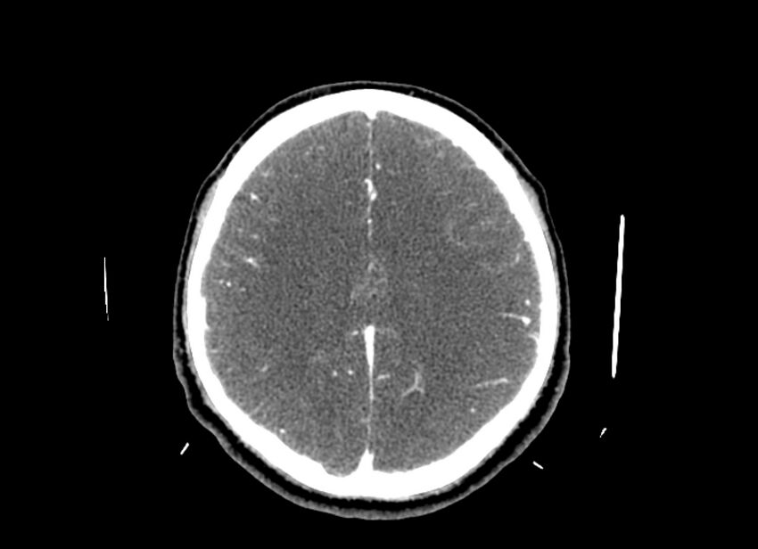 Cerebral edema (Radiopaedia 82519-96661 B 22).jpg