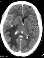 Cerebral metastasis - lung cancer (Radiopaedia 5315-7072 Axial C+ delayed 2).jpg