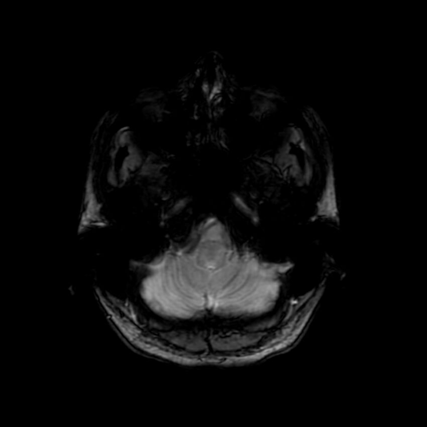 Cerebral paragonimiasis (Radiopaedia 73473-84238 Axial SWI 12).jpg