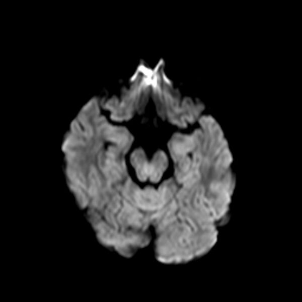 File:Cerebral tuberculoma (Radiopaedia 41152-43932 Axial DWI 7).jpg